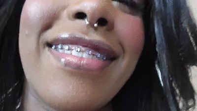 Black Girl Teeth Brace Fetish!